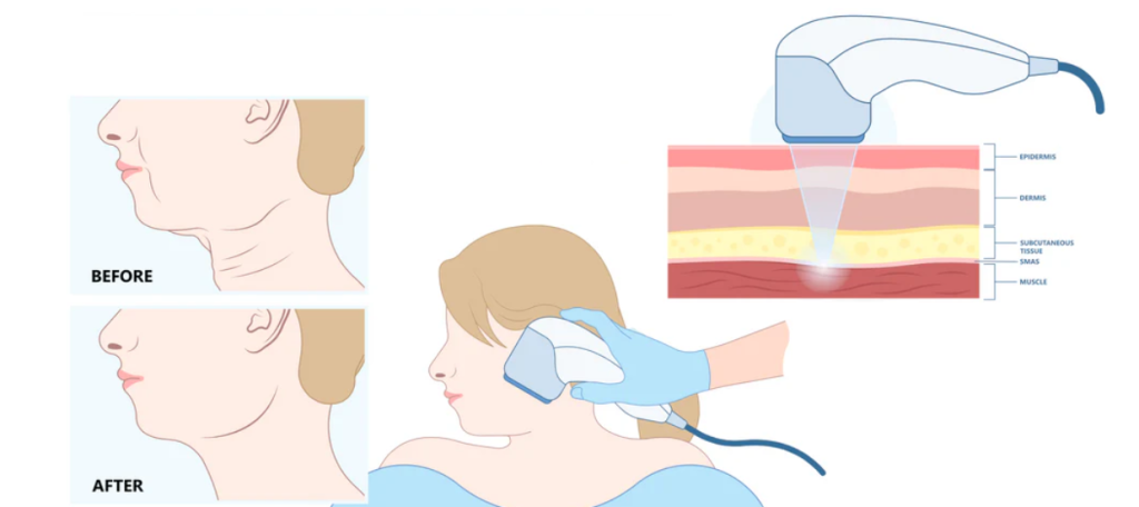 hifu for anti-aging