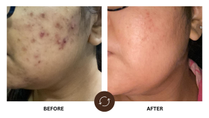 ba 08 - Dr. Reshma Ahuja | Best Dermatologist and Skin Specialist in Powai