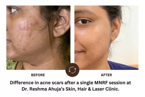 Difference in Acne Scars - Vivace MNRF based Acne Scar Treatment in Powai - Dr. Reshma Ahuja