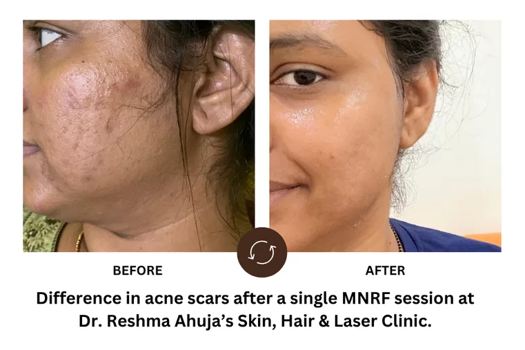 Difference in Acne Scars - Dr. Reshma Ahuja