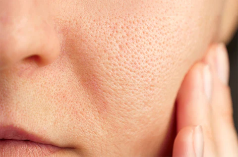 Open pores treatment in Powai by Dr. Reshma Ahuja - Best skin doctor in Powai
