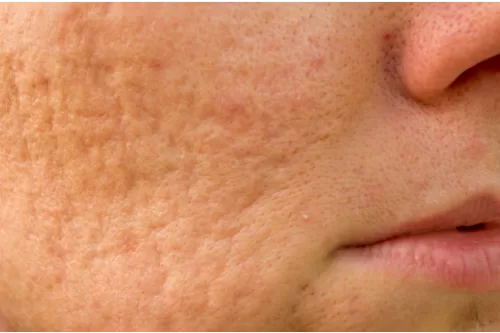 Types of Acne Scars
