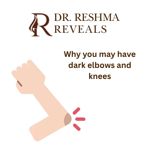 Why you have dark elbows and knees | Dr. Reshma Reveals