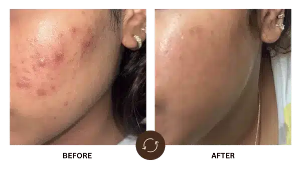 Difference in Acne & Acne Scar Treatment in Powai - Dr. Reshma Ahuja