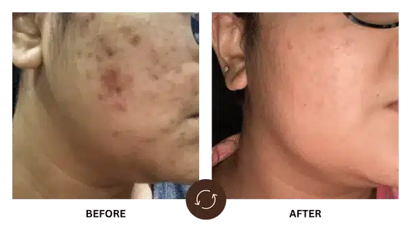 Difference in Acne & Acne Scar Treatment in Powai - Dr. Reshma Ahuja