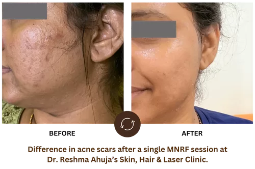 Difference in Acne Scars - Vivace MNRF based Acne Scar Treatment in Powai - MNRF treatment for Acne Scars - Dr. Reshma Ahuja